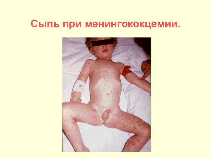 Сыпь при менингококцемии. 