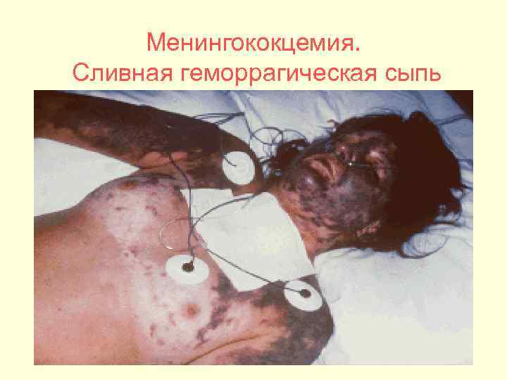  Менингококцемия. Сливная геморрагическая сыпь 