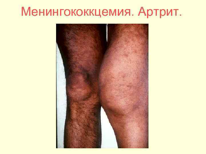 Менингококкцемия. Артрит. 