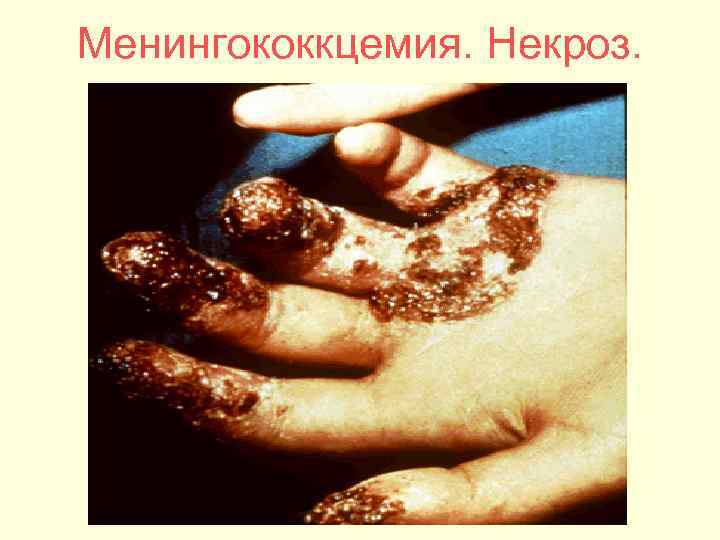 Менингококкцемия. Некроз. 