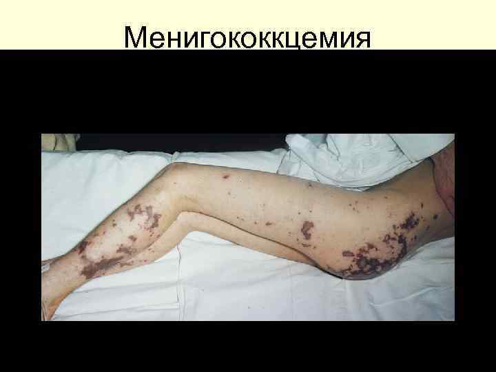 Менигококкцемия 