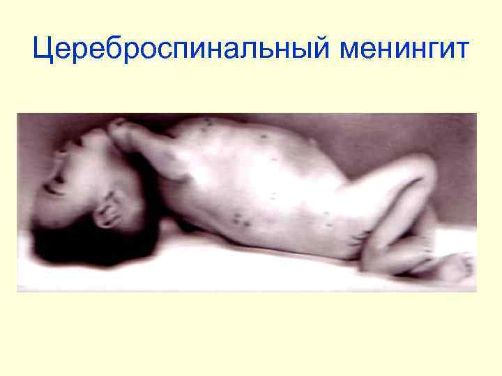 Цереброспинальный менингит 
