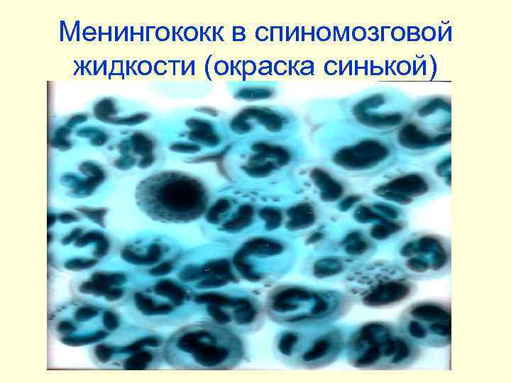 Менингококк в спиномозговой жидкости (окраска синькой) 
