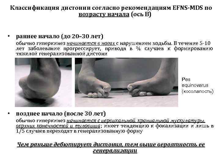 Классификация дистонии согласно рекомендациям EFNS-MDS по    возрасту начала (ось В) 