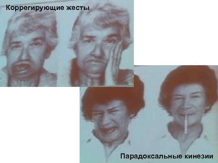 Коррегирующие жесты      Парадоксальные кинезии 