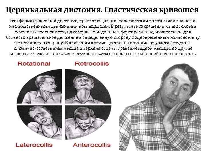 Цервикальная дистония. Спастическая кривошея  Это форма фокальной дистонии, проявляющаяся патологическим положением головы и