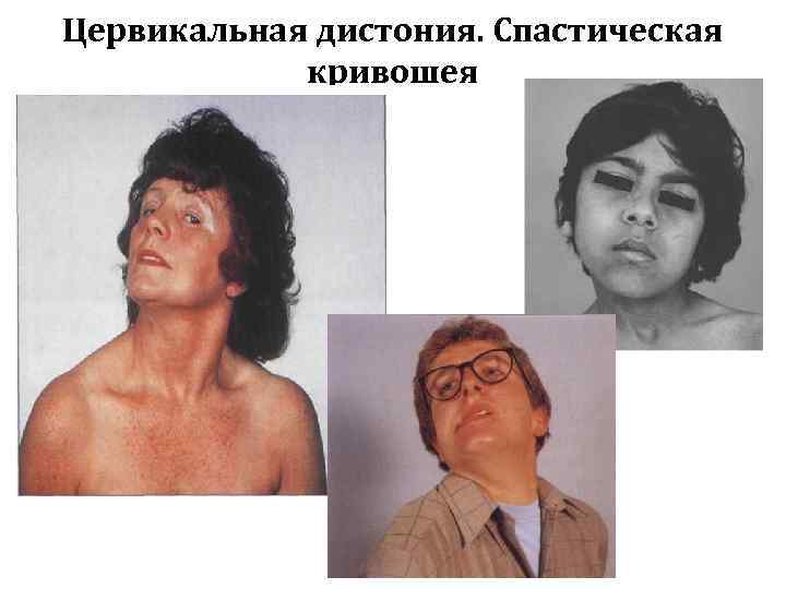 Цервикальная дистония. Спастическая   кривошея 