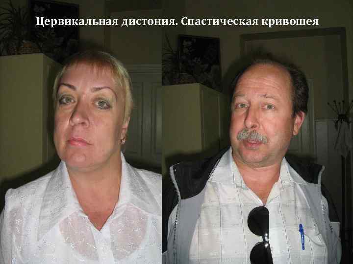 Цервикальная дистония. Спастическая кривошея 