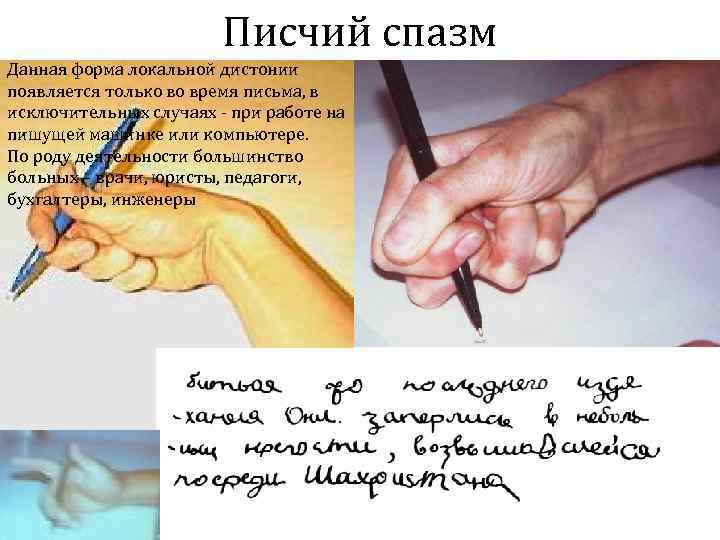     Писчий спазм Данная форма локальной дистонии появляется только во время