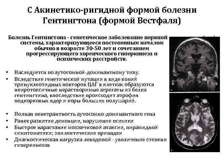   С Акинетико-ригидной формой болезни   Гентингтона (формой Вестфаля) Болезнь Гентингтона -