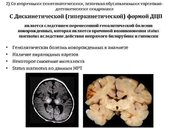 2) Со вторичными симптоматическими, экзогенно обусловленными торсионно-    дистоническими синдромами С Дискинетической