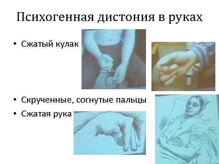 Психогенная дистония в руках • Сжатый кулак • Скрученные, согнутые пальцы • Сжатая рука