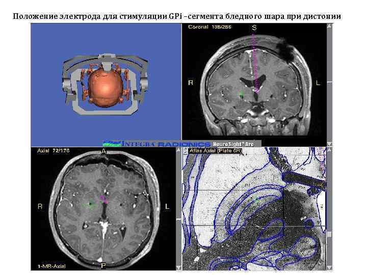 Положение электрода для стимуляции GPi –сегмента бледного шара при дистонии 