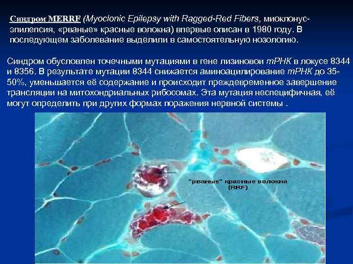 Синдром MERRF (Myoclonic Epilepsy with Ragged-Red Fibers, миоклонус эпилепсия,  «рваные» красные волокна) впервые