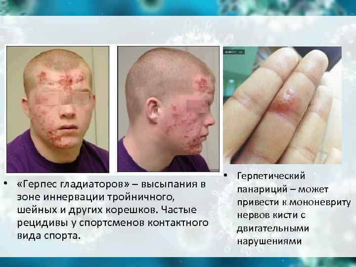 • Герпетический • «Герпес гладиаторов» – высыпания в панариций • Герпетический • «Герпес гладиаторов» – высыпания в панариций