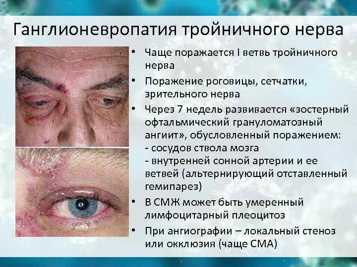 Ганглионевропатия тройничного нерва • Чаще поражается I ветвь тройничного Ганглионевропатия тройничного нерва • Чаще поражается I ветвь тройничного