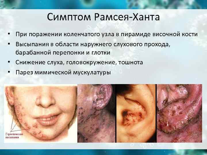 Симптом Рамсея-Ханта • При поражении коленчатого узла в пирамиде височной кости • Симптом Рамсея-Ханта • При поражении коленчатого узла в пирамиде височной кости •