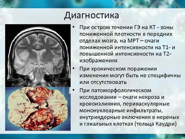 Диагностика • При остром течении ГЭ на КТ - зоны пониженной плотности Диагностика • При остром течении ГЭ на КТ - зоны пониженной плотности