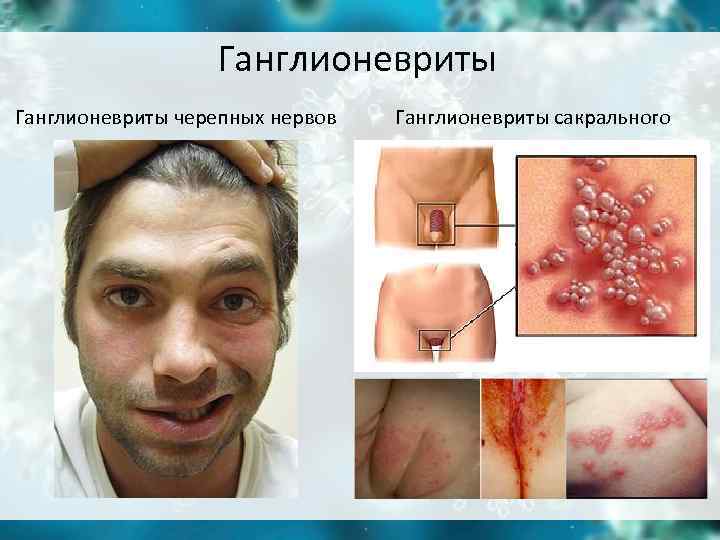 Ганглионевриты черепных нервов Ганглионевриты сакрального отдела Ганглионевриты черепных нервов Ганглионевриты сакрального отдела
