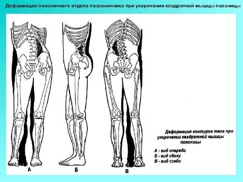 Деформация поясничного отдела позвоночника при укорочении квадратной мышцы поясницы 