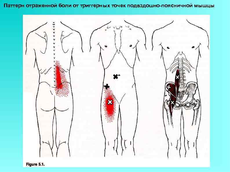 Паттерн отраженной боли от триггерных точек подвздошно-поясничной мышцы 