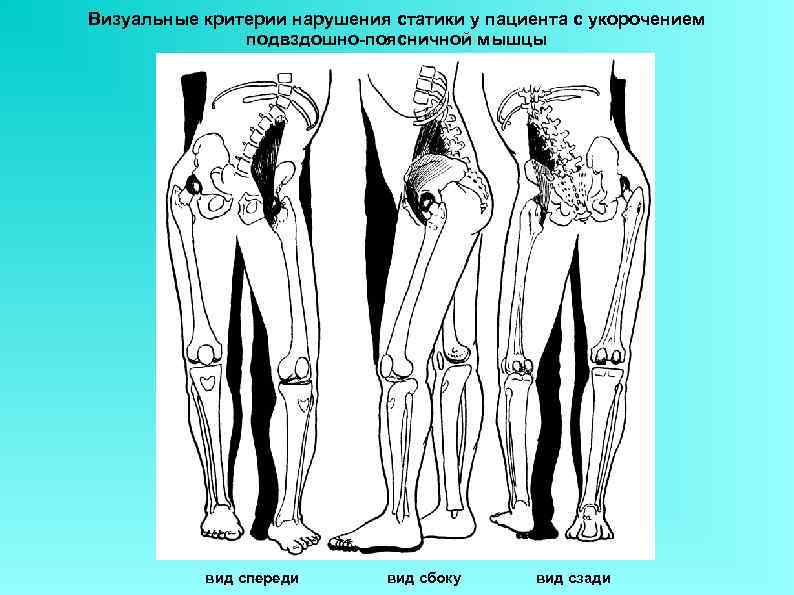 Визуальные критерии нарушения статики у пациента с укорочением    подвздошно-поясничной мышцы 