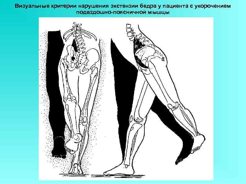 Визуальные критерии нарушения экстензии бедра у пациента с укорочением    подвздошно-поясничной мышцы