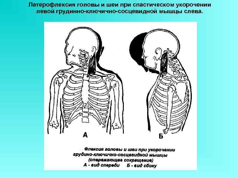 Латерофлексия головы и шеи при спастическом укорочении  левой грудинно-ключично-сосцевидной мышцы слева. 