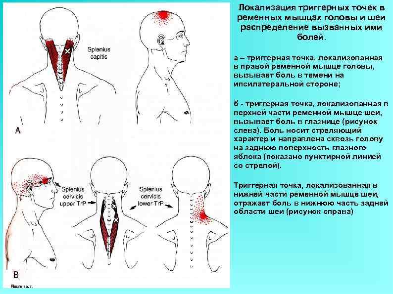 Локализация триггерных точек в ременных мышцах головы и шеи распределение вызванных ими  
