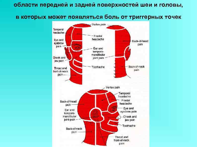 области передней и задней поверхностей шеи и головы,  в которых может появляться боль