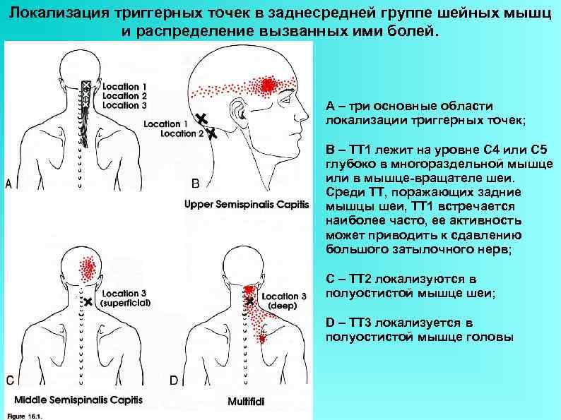 Локализация триггерных точек в заднесредней группе шейных мышц   и распределение вызванных ими