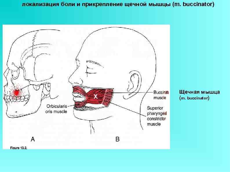 локализация боли и прикрепление щечной мышцы (m. buccinator)     Щечная мышца
