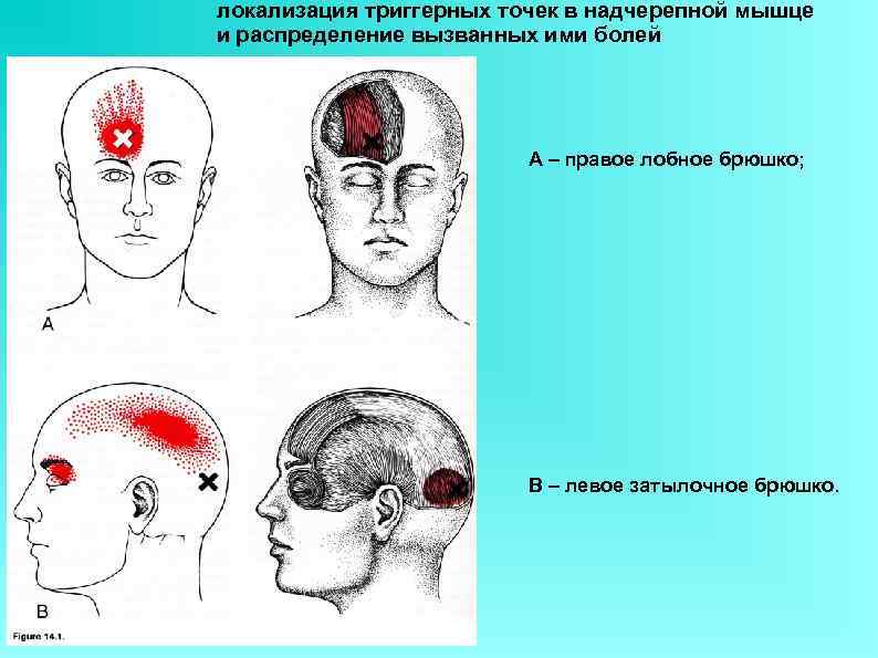 локализация триггерных точек в надчерепной мышце и распределение вызванных ими болей   