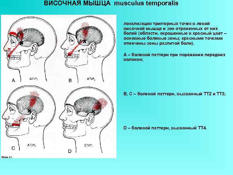 ВИСОЧНАЯ МЫШЦА musculus temporalis    локализация триггерных точек в левой  