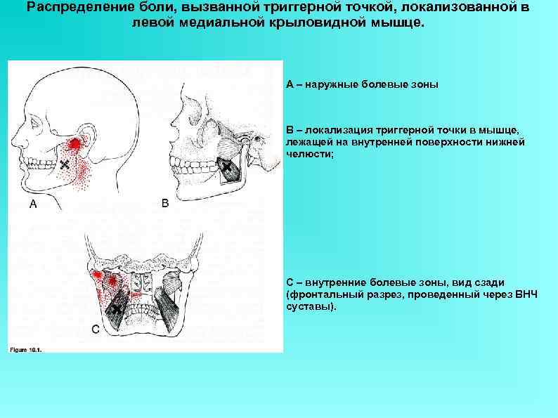 Распределение боли, вызванной триггерной точкой, локализованной в   левой медиальной крыловидной мышце. 