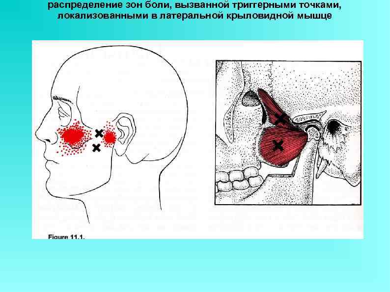 распределение зон боли, вызванной триггерными точками,  локализованными в латеральной крыловидной мышце 
