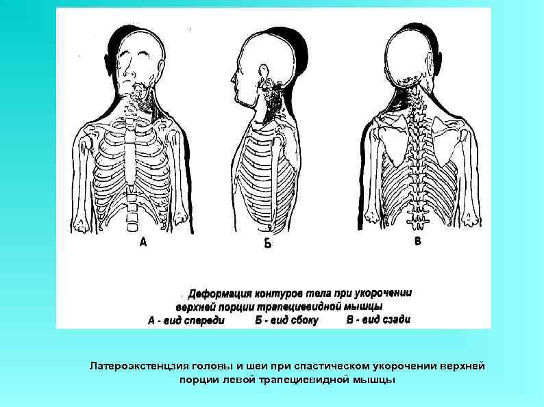 Латероэкстенцзия головы и шеи при спастическом укорочении верхней    порции левой трапециевидной