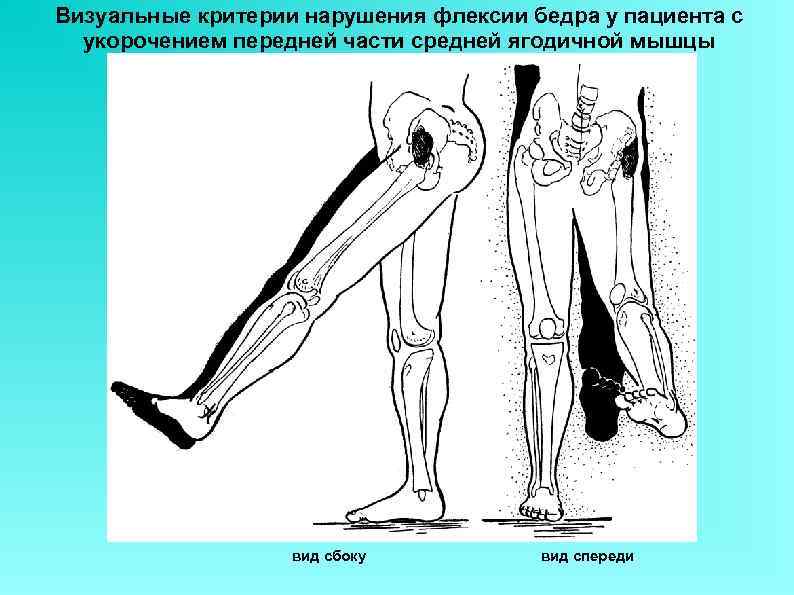 Визуальные критерии нарушения флексии бедра у пациента с  укорочением передней части средней ягодичной