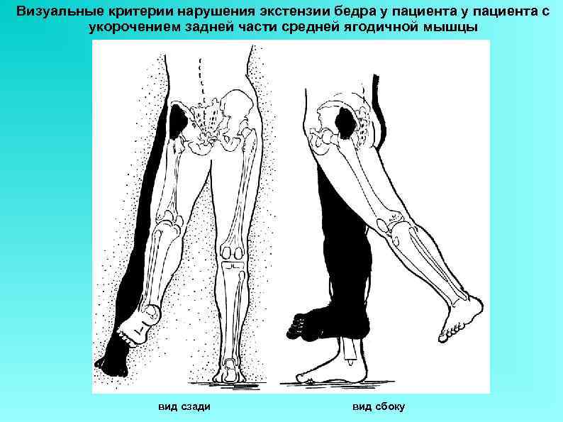 Визуальные критерии нарушения экстензии бедра у пациента с   укорочением задней части средней