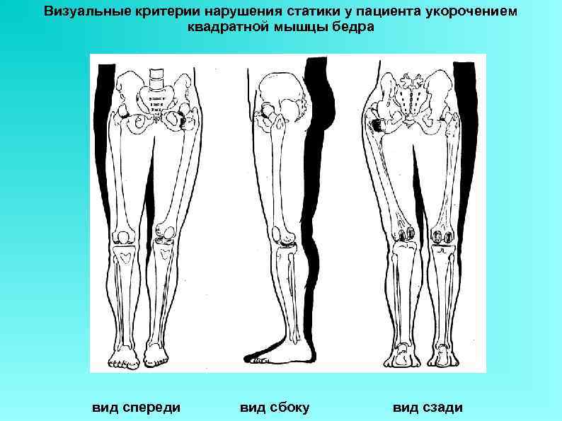 Визуальные критерии нарушения статики у пациента укорочением   квадратной мышцы бедра  вид
