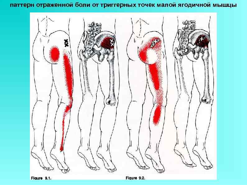 паттерн отраженной боли от триггерных точек малой ягодичной мышцы 