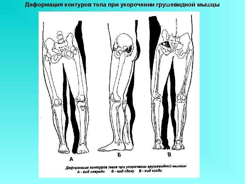 Деформация контуров тела при укорочении грушевидной мышцы 