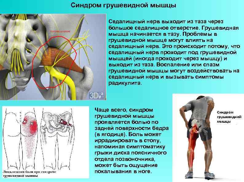 Седалищный нерв где расположен фото