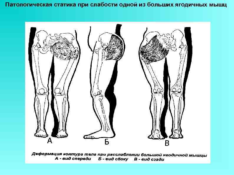 Патологическая статика при слабости одной из больших ягодичных мышц 