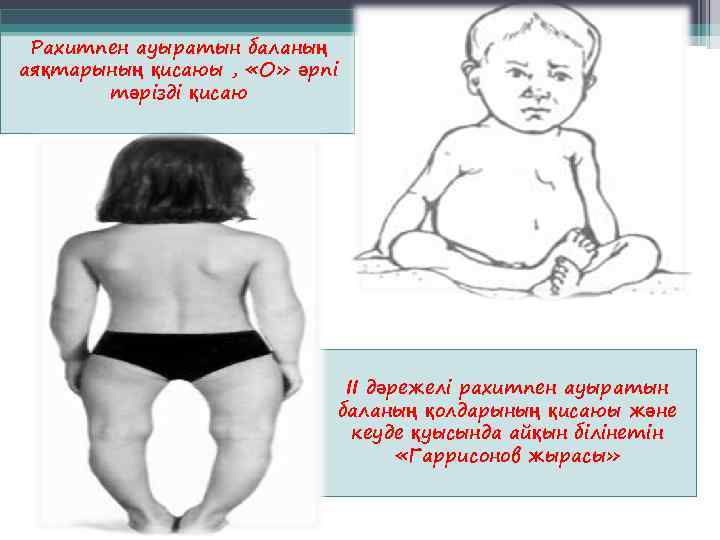  Рахитпен ауыратын баланың аяқтарының қисаюы ,  «О» әрпі  тәрізді қисаю 