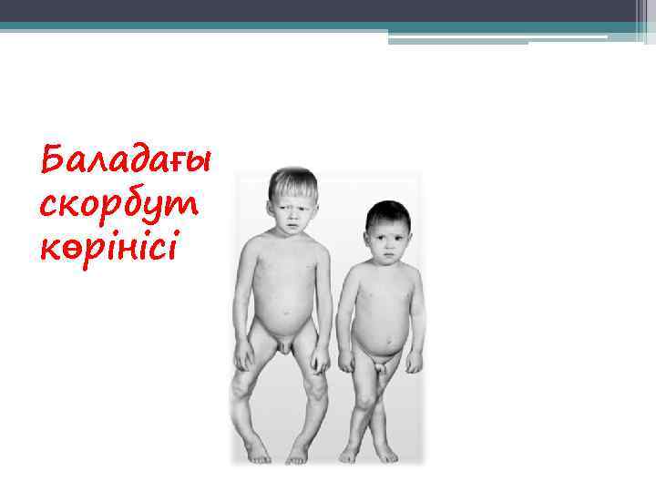 Баладағы скорбут көрінісі 