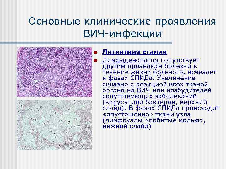 Основные клинические проявления   ВИЧ инфекции  n  Латентная стадия  n