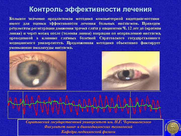    Контроль эффективности лечения Большое значение предлагаемая методика компьютерной видеодиагностики имеет для