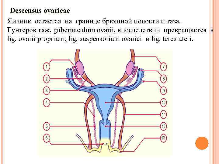  Descensus ovaricae Яичник остается на границе брюшной полости и таза. Гунтеров тяж, gubernaculum
