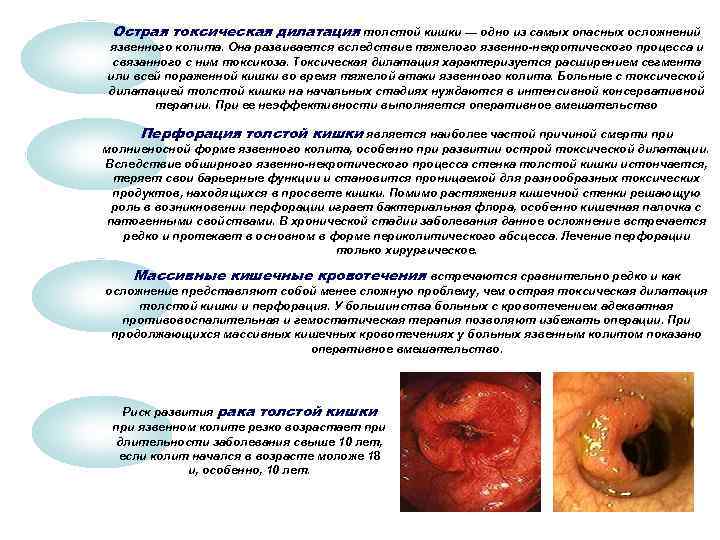  Острая токсическая дилатация толстой кишки — одно из самых опасных осложнений язвенного колита.
